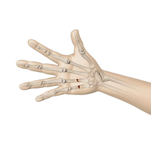 Fractures of the Hand